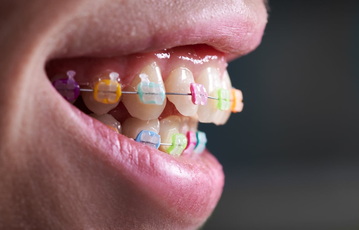 Macro snapshot of white teeth and ceramic braces with colorful rubber bands on them, beautiful smile